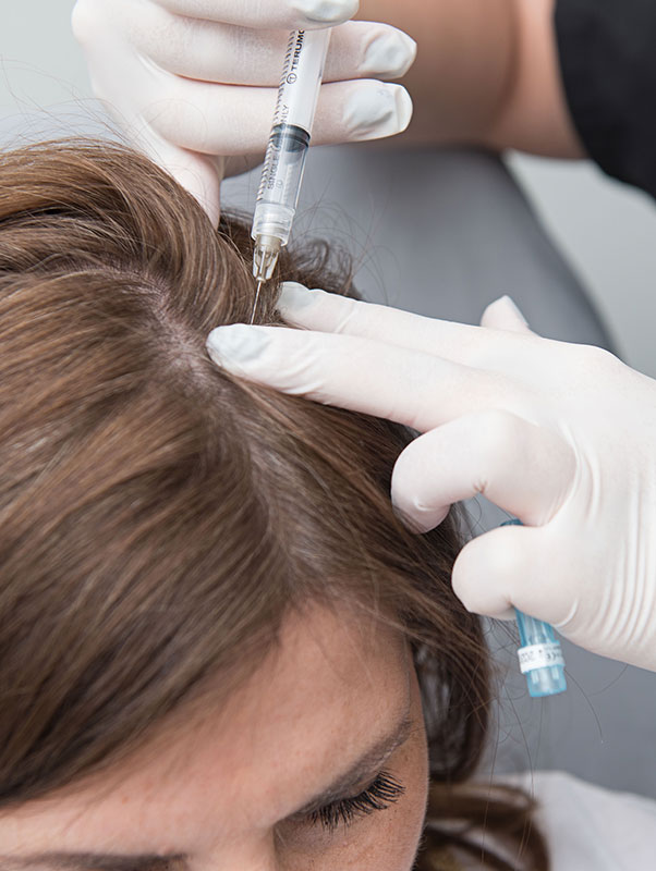 PRP hair loss therapy in Weston